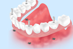 オールオン4（オールオン6）ってどんな治療？